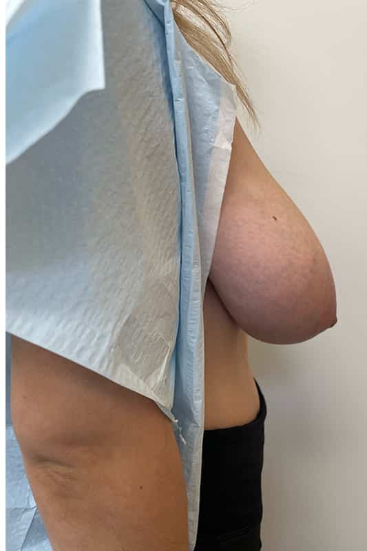 Breast Lift Before & After Image