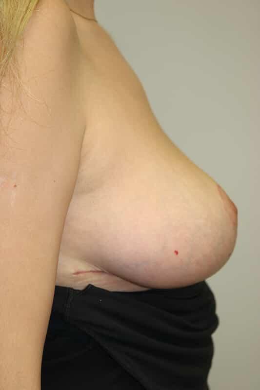 Breast Lift Before & After Image