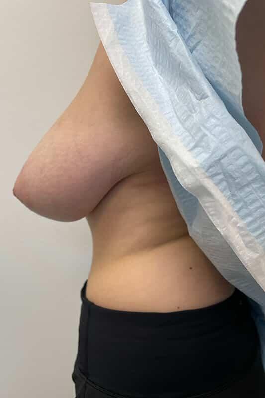 Breast Lift Before & After Image