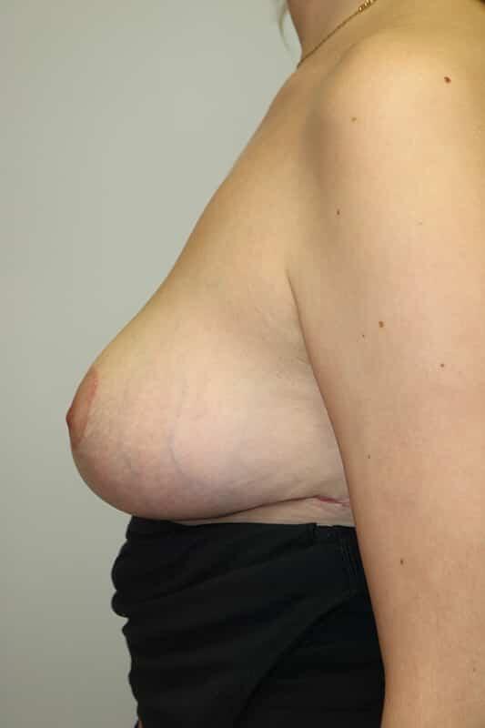 Breast Lift Before & After Image