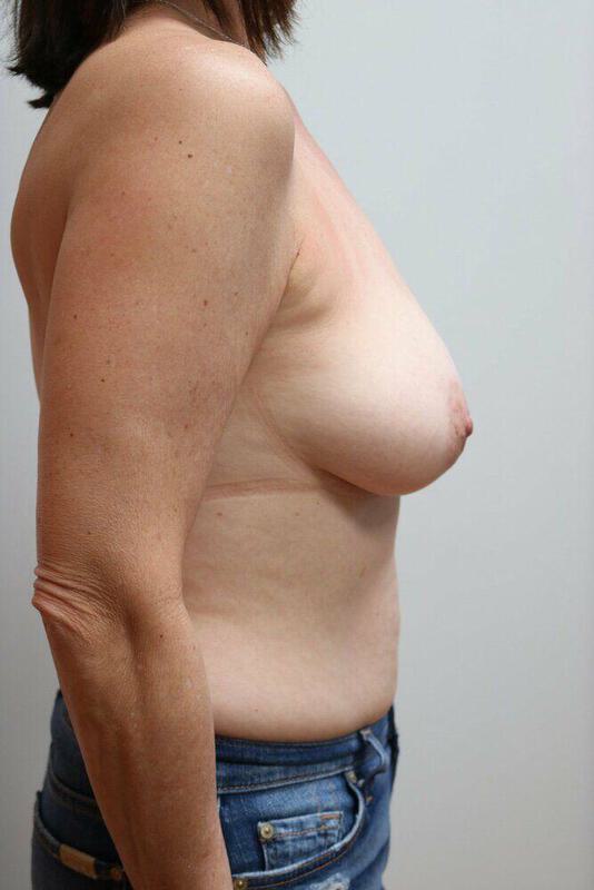 Breast Reduction Before & After Image