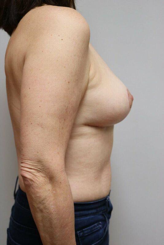 Breast Reduction Before & After Image