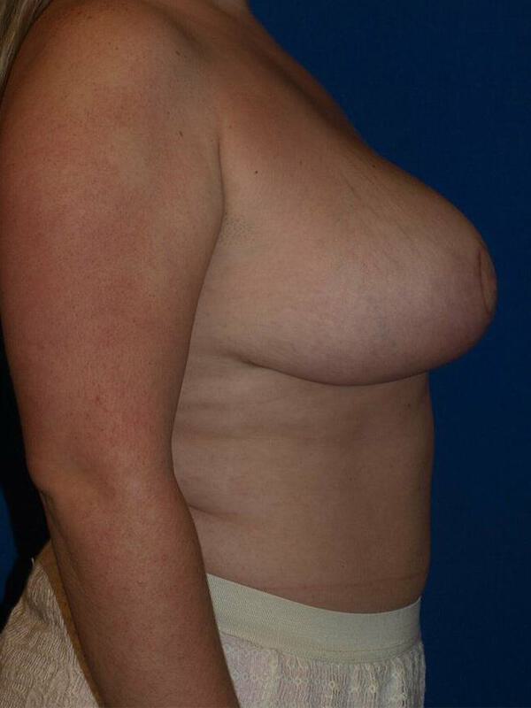 Breast Reduction Before & After Image