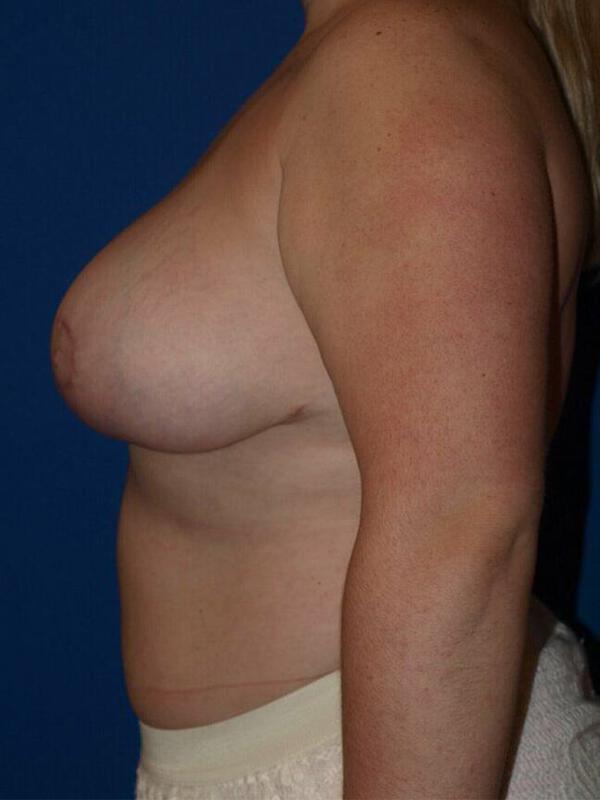 Breast Reduction Before & After Image