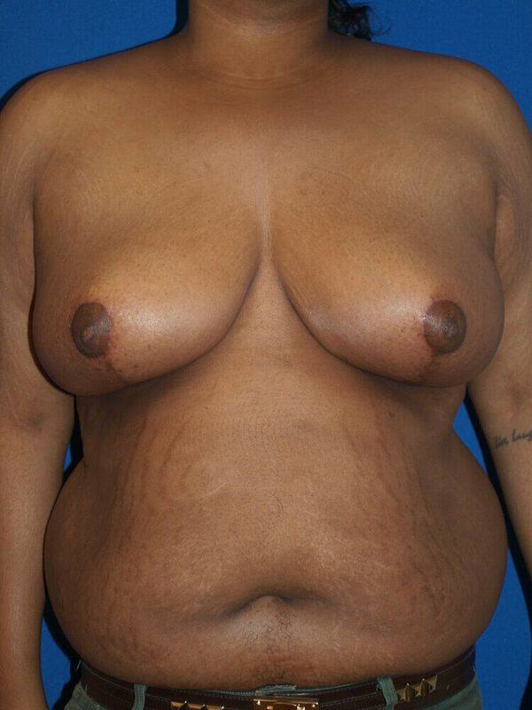 Breast Reduction Before & After Image