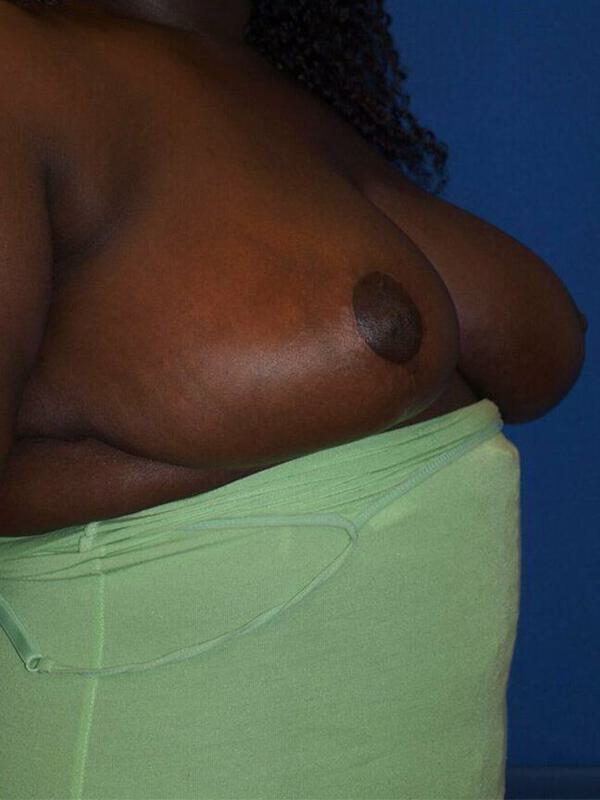 Breast Reduction Before & After Image