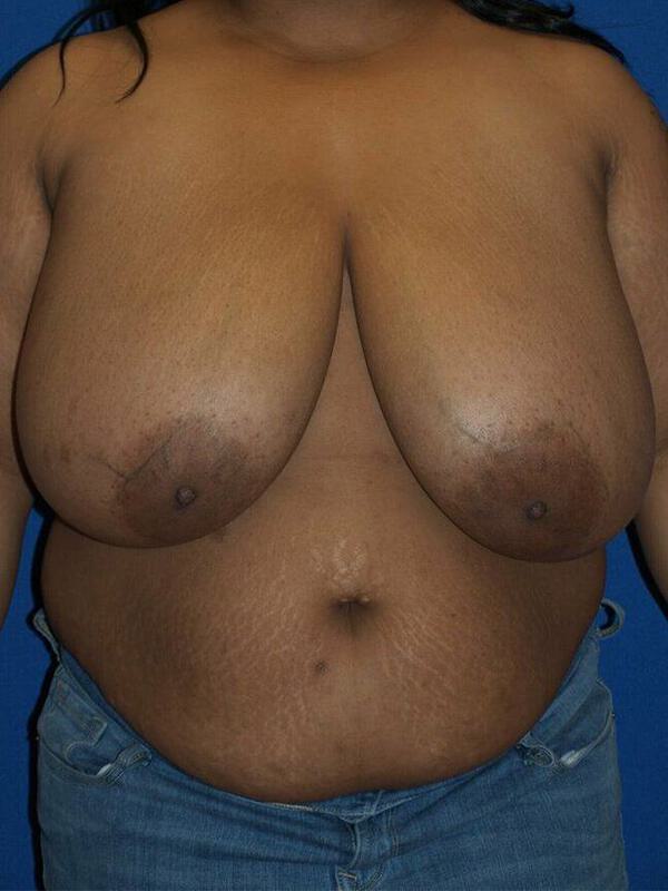 Breast Reduction Before & After Image