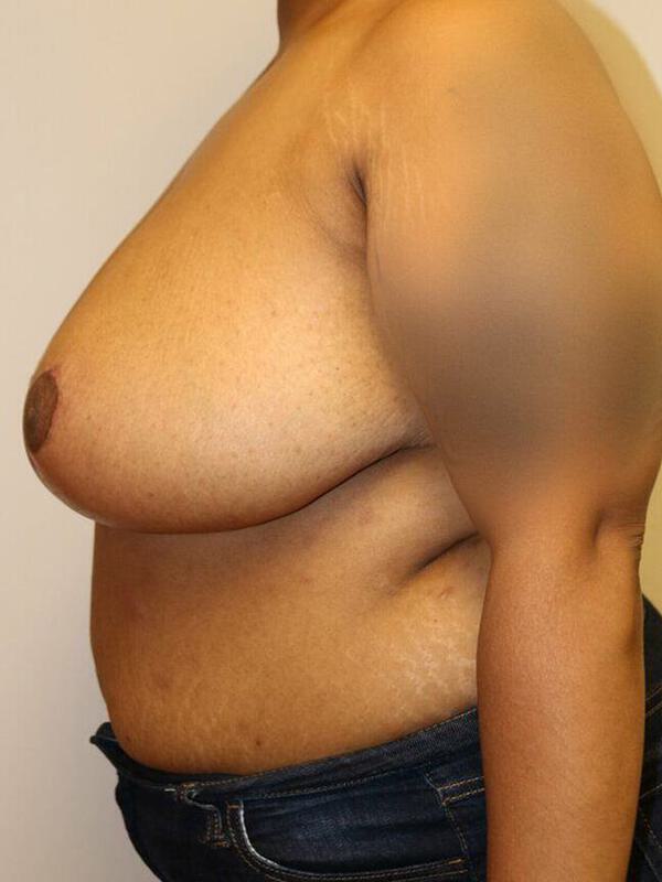 Breast Reduction Before & After Image