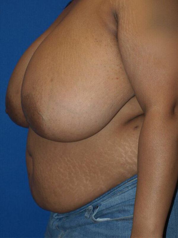 Breast Reduction Before & After Image