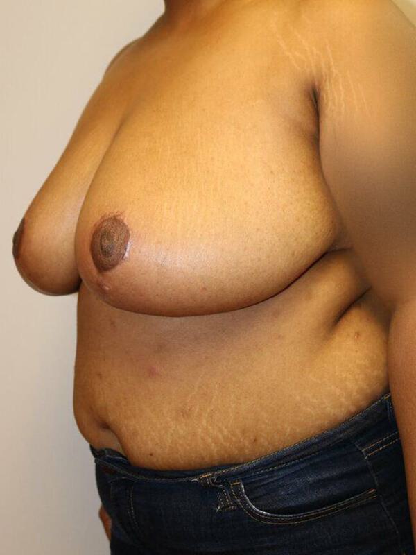 Breast Reduction Before & After Image