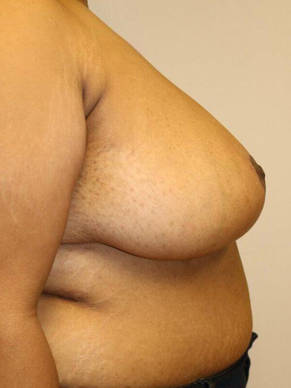 Breast Reduction Before & After Image