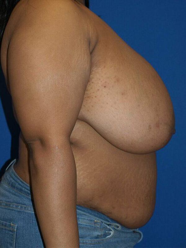 Breast Reduction Before & After Image