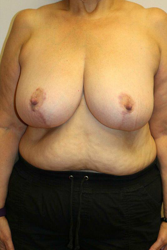 Breast Reduction Before and After | ARC Plastic Surgery