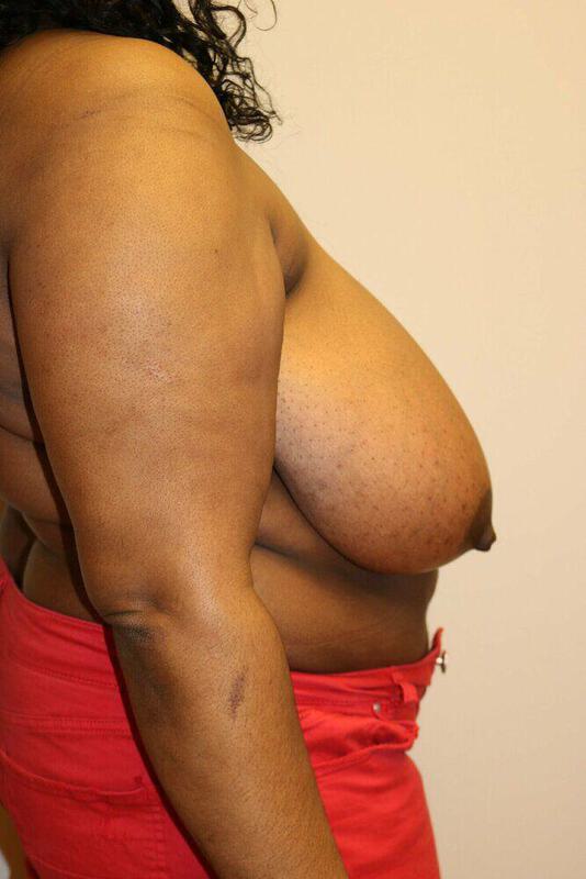 Breast Reduction Before & After Image