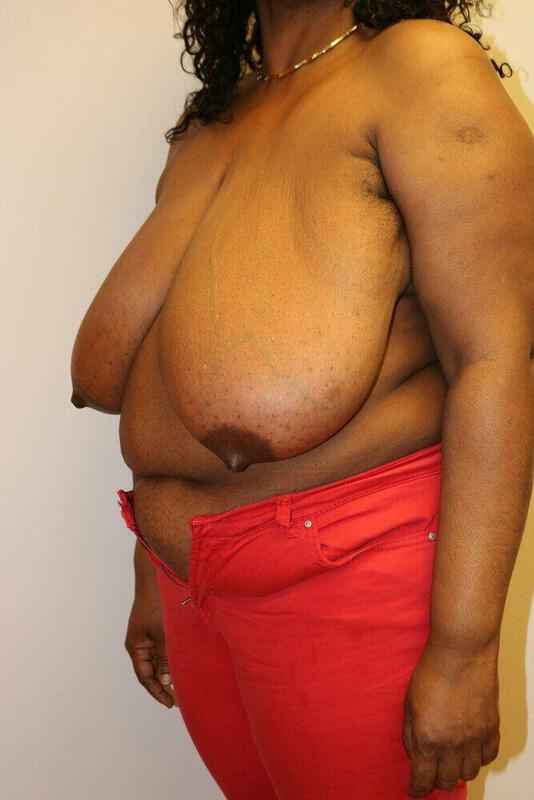 Breast Reduction Before & After Image