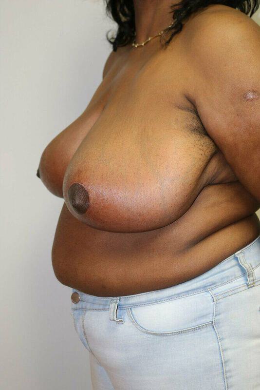 Breast Reduction Before & After Image