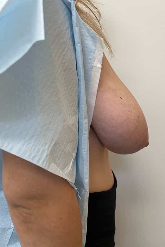 Breast Reduction Before & After Image