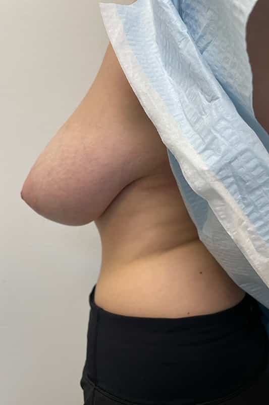 Breast Reduction Before & After Image