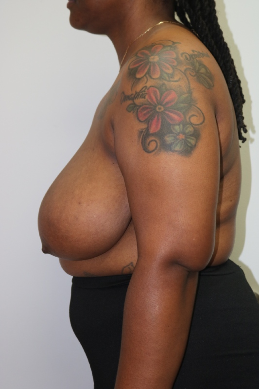 Breast Reduction Before & After Image
