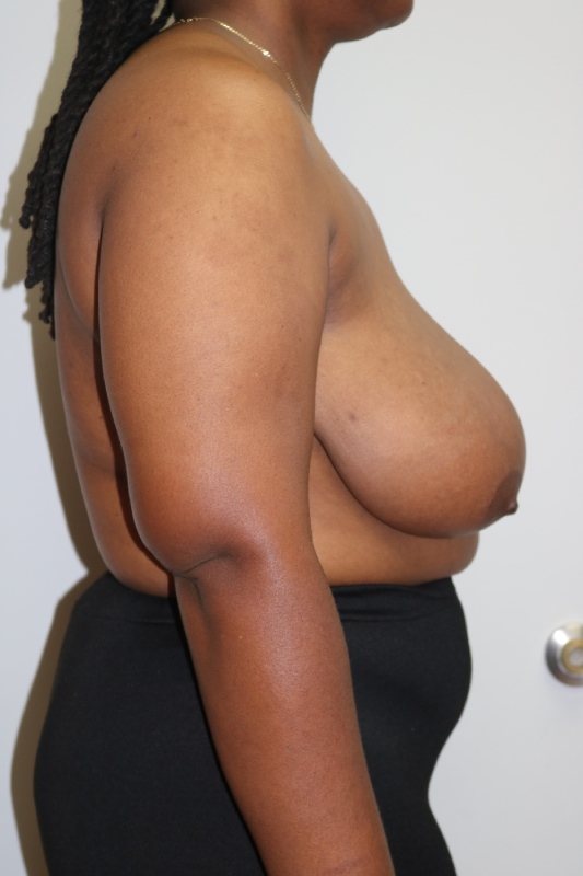 Breast Reduction Before & After Image