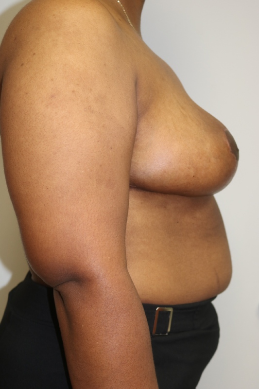 Breast Reduction Before & After Image