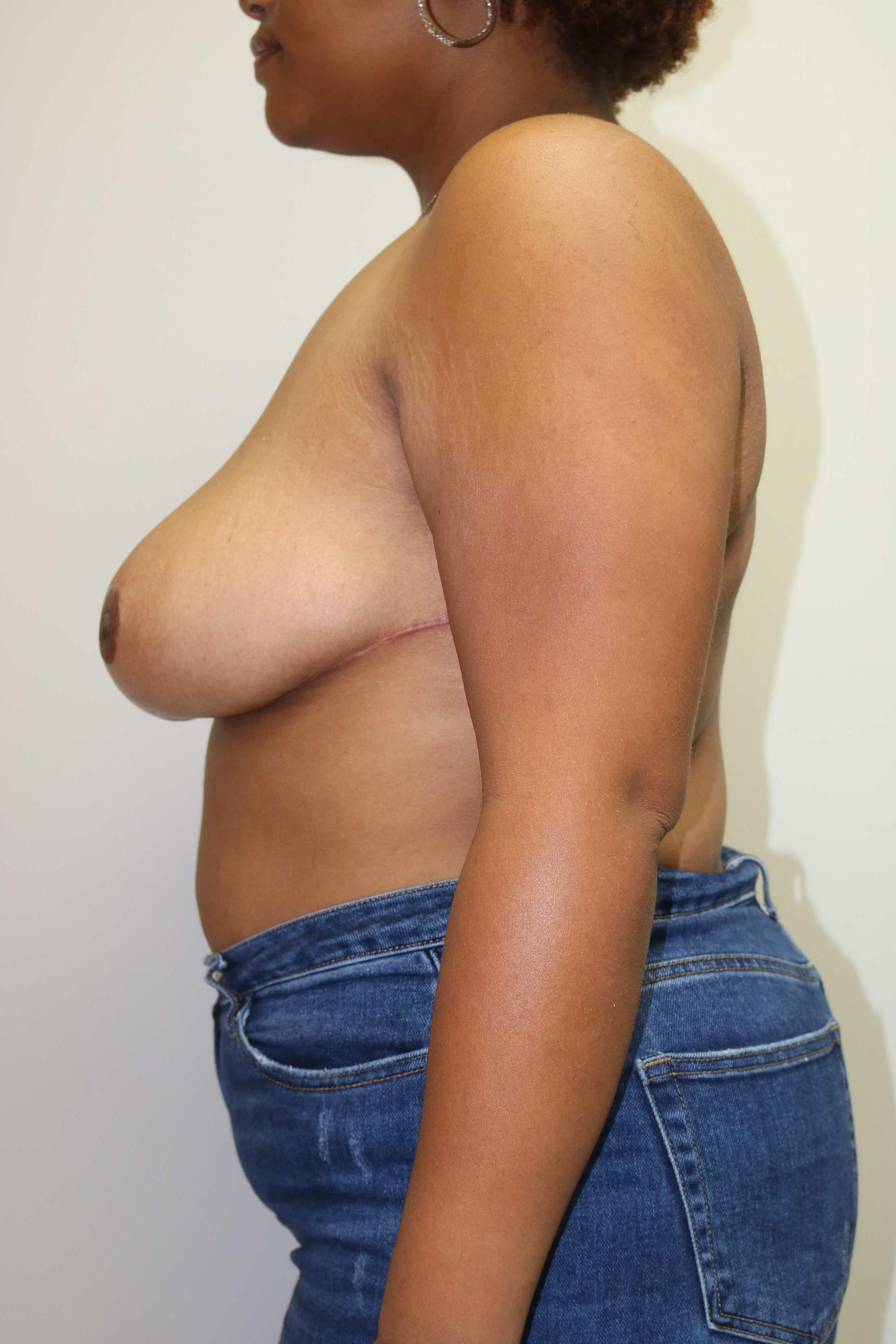 Breast Reduction Before & After