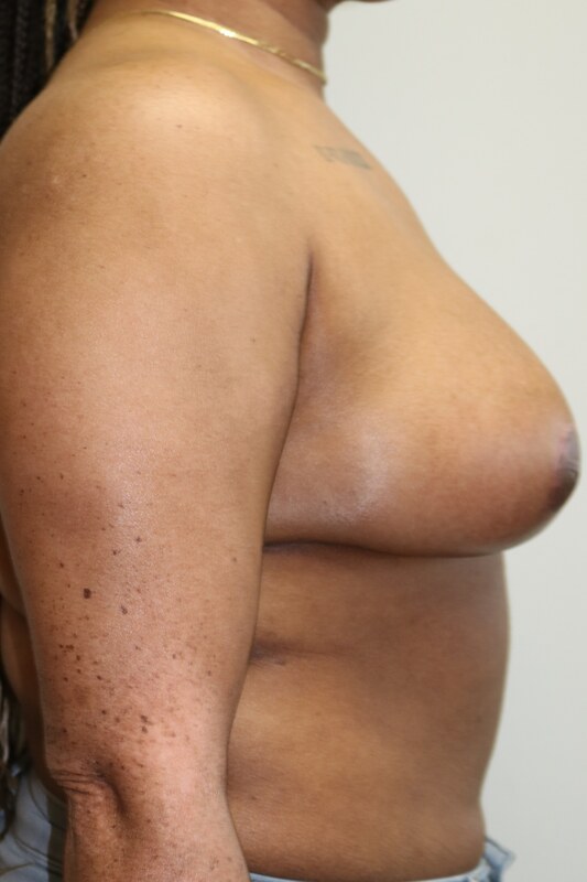 Breast Reduction Before & After