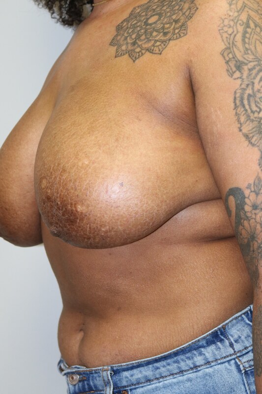 Breast Reduction Before & After