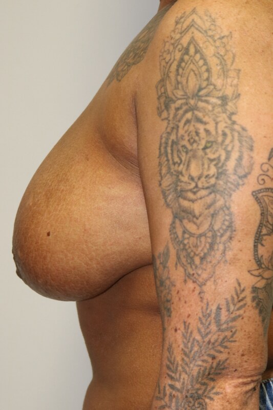 Breast Reduction Before & After