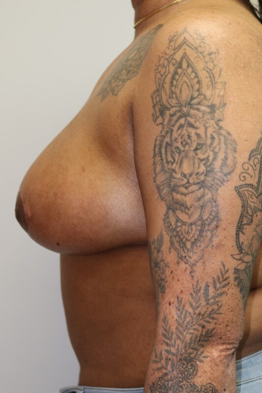 Breast Reduction Before & After