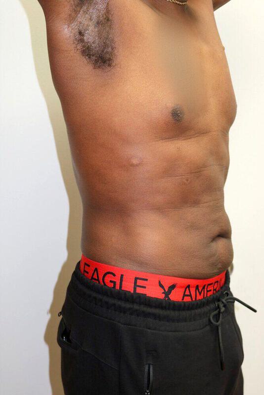Gynecomastia Surgery Before & After Image