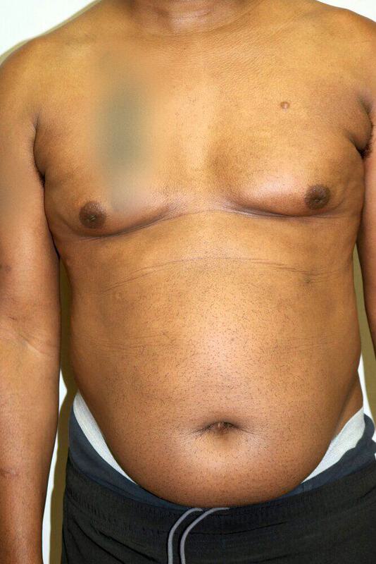 Gynecomastia Surgery Before & After Image