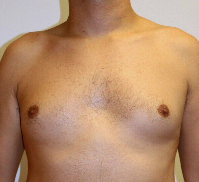 Gynecomastia Surgery Before & After Image