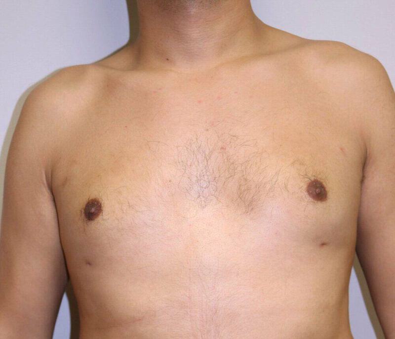 Gynecomastia Surgery Before & After Image