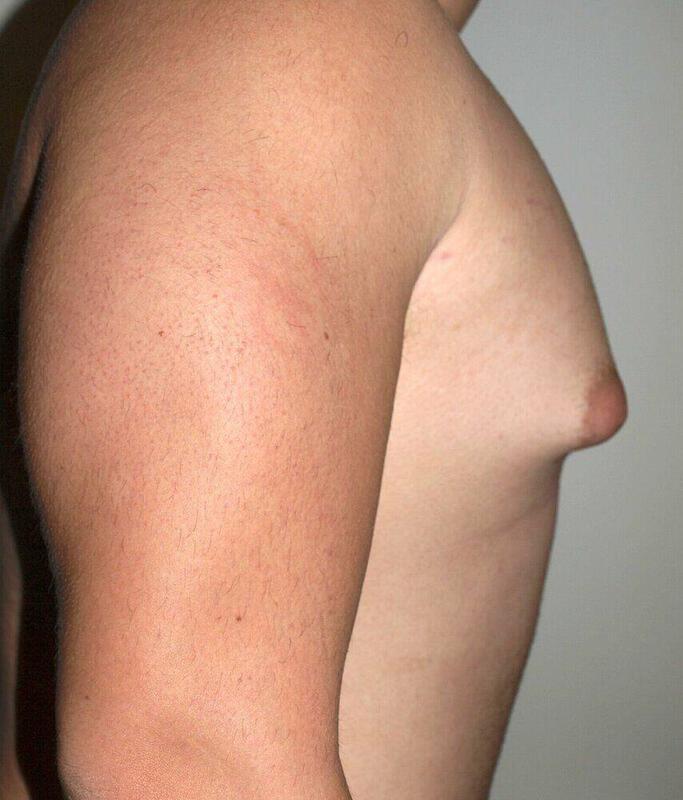 Gynecomastia Surgery Before & After Image