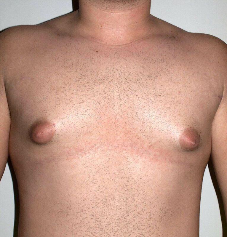 Gynecomastia Surgery Before & After Image