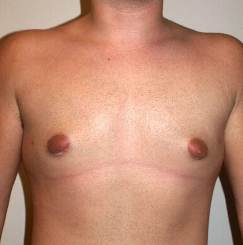 Gynecomastia Surgery Before & After Image