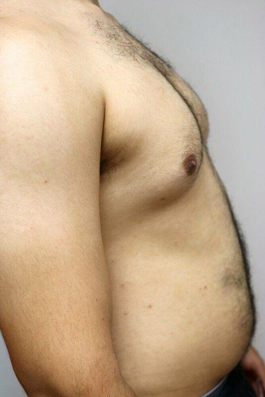 Gynecomastia Before and After 03 | ARC Plastic Surgery