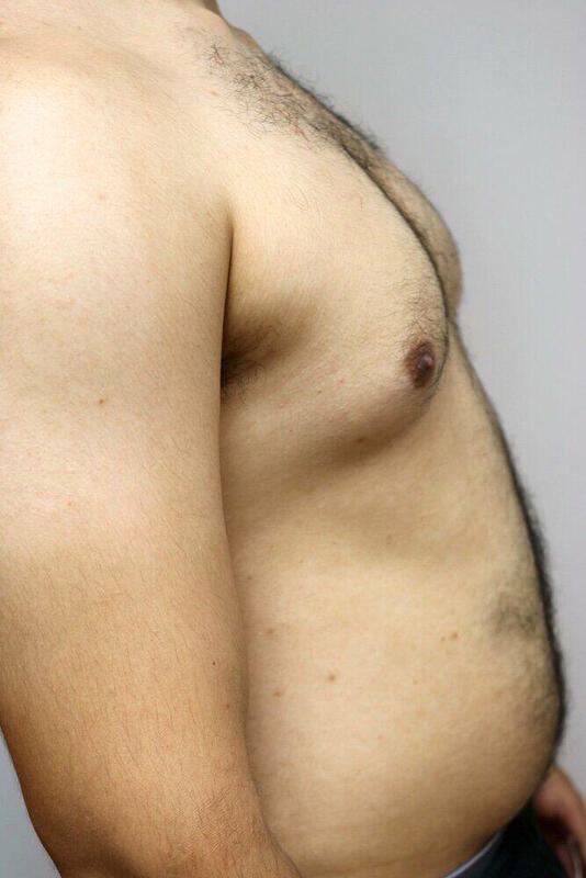 Gynecomastia Surgery Before & After Image