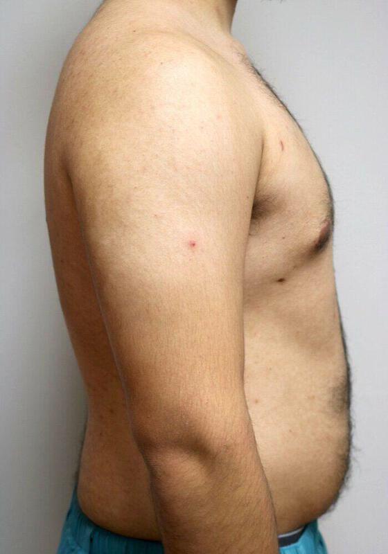 Gynecomastia Surgery Before & After Image