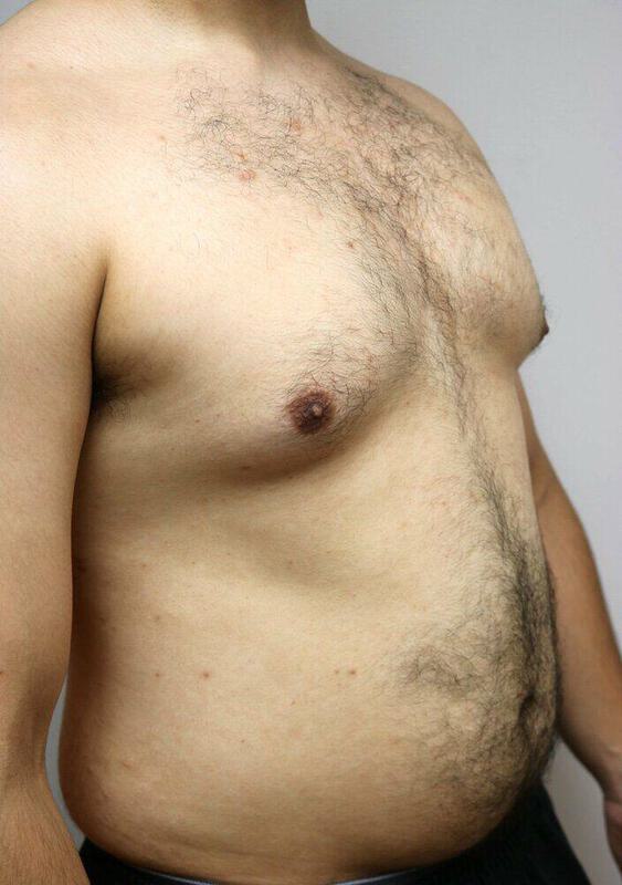 Gynecomastia Surgery Before & After Image