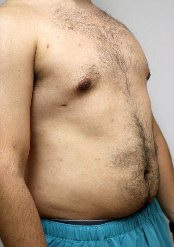 Gynecomastia Surgery Before & After Image