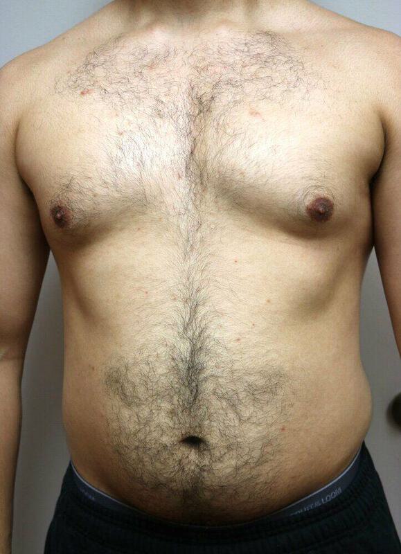 Gynecomastia Before & After Image