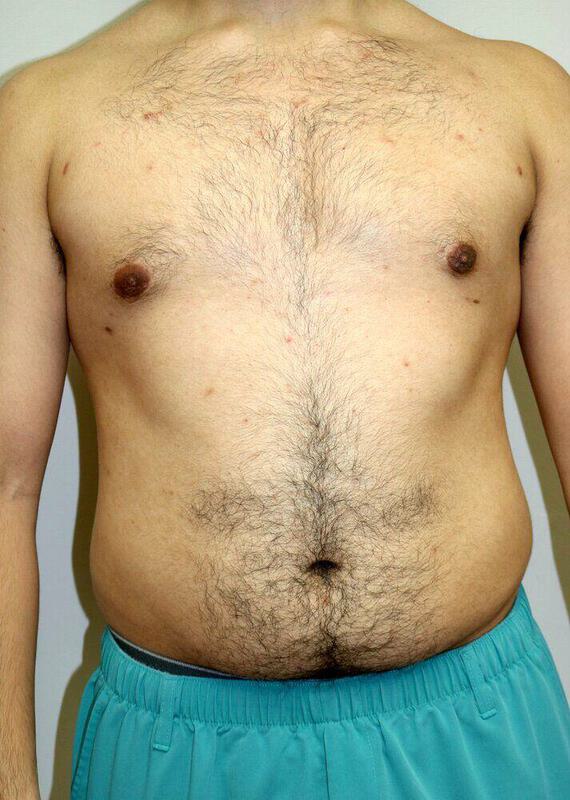 Gynecomastia Surgery Before & After Image