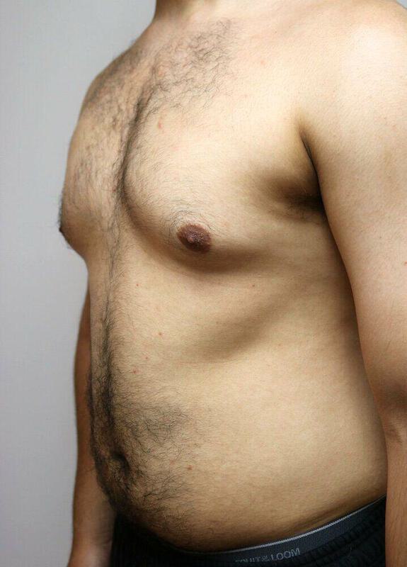 Gynecomastia Surgery Before & After Image