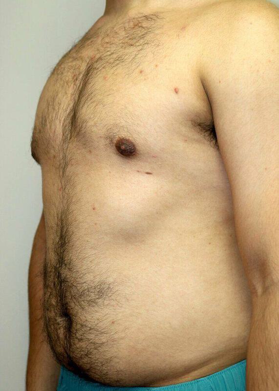 Gynecomastia Surgery Before & After Image