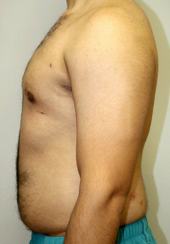 Gynecomastia Surgery Before & After Image