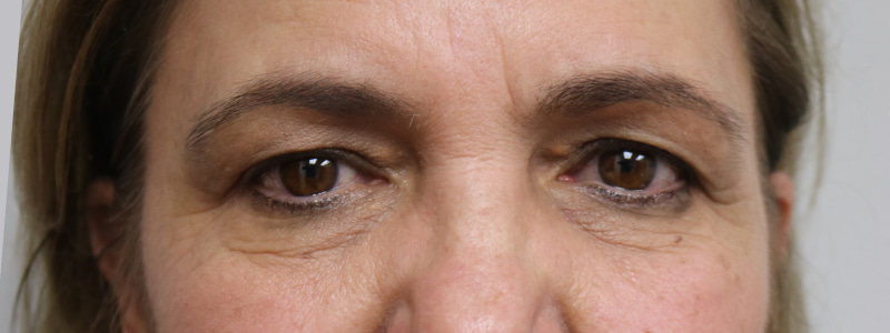 Brow Lift Before & After