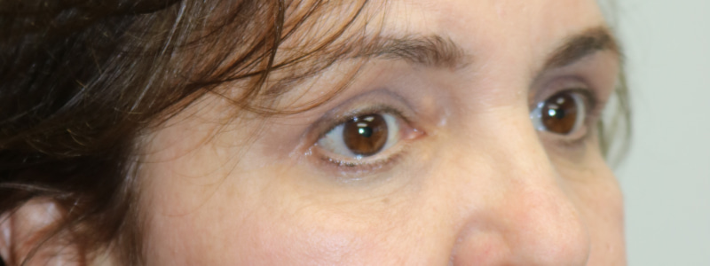Brow Lift Before & After