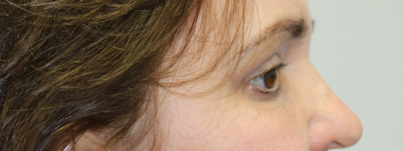 Brow Lift Before & After